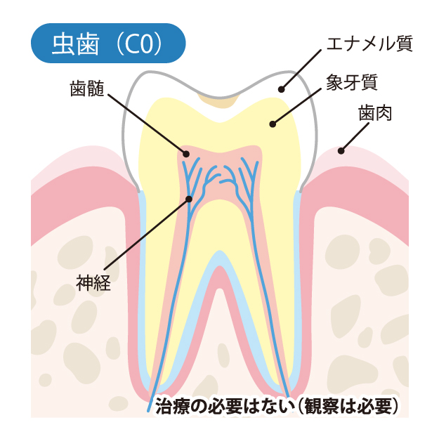 綾瀬の歯医者、新井歯科医のむし歯治療