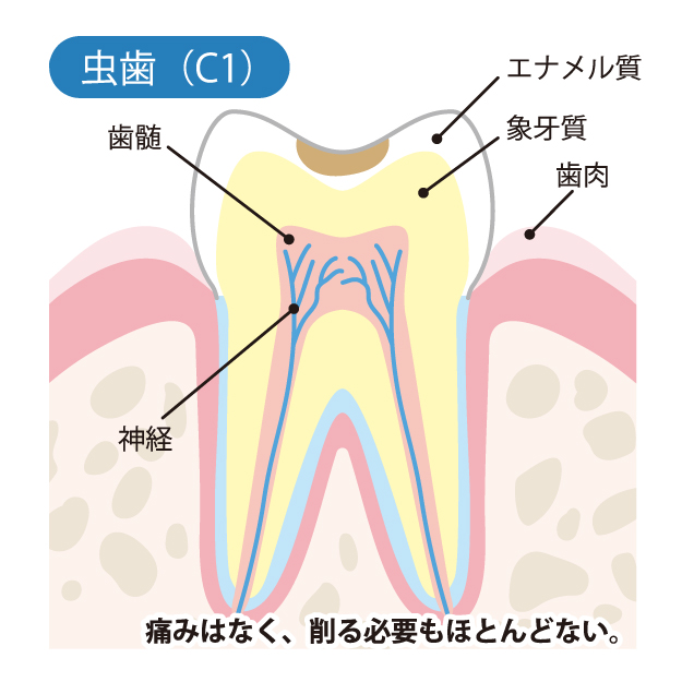 綾瀬の歯医者、新井歯科医のむし歯治療