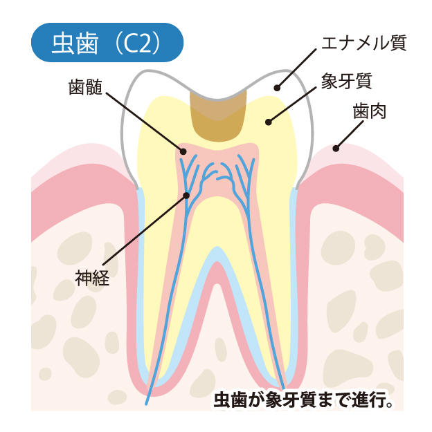 綾瀬の歯医者、新井歯科医のむし歯治療