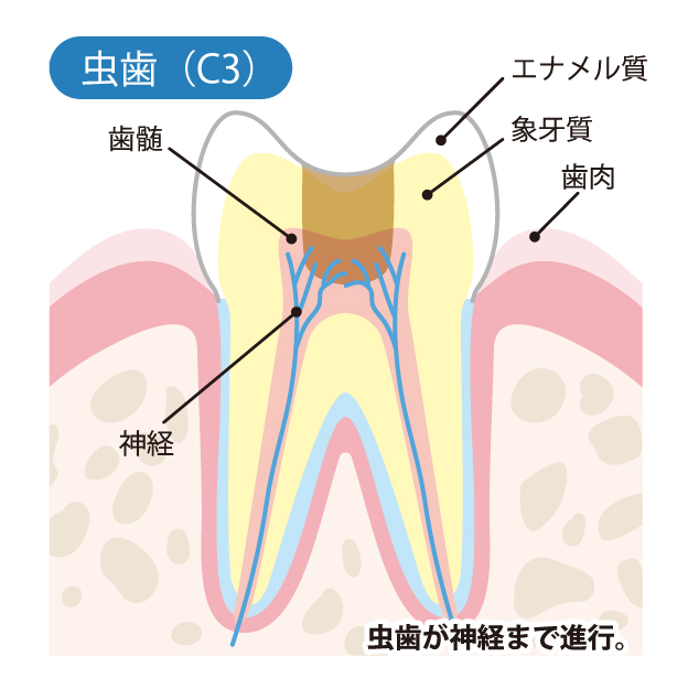 綾瀬の歯医者、新井歯科医のむし歯治療