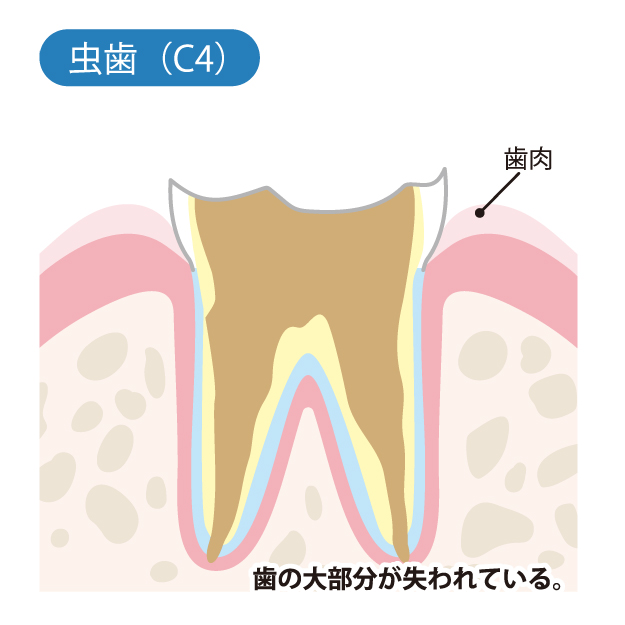 綾瀬の歯医者、新井歯科医のむし歯治療