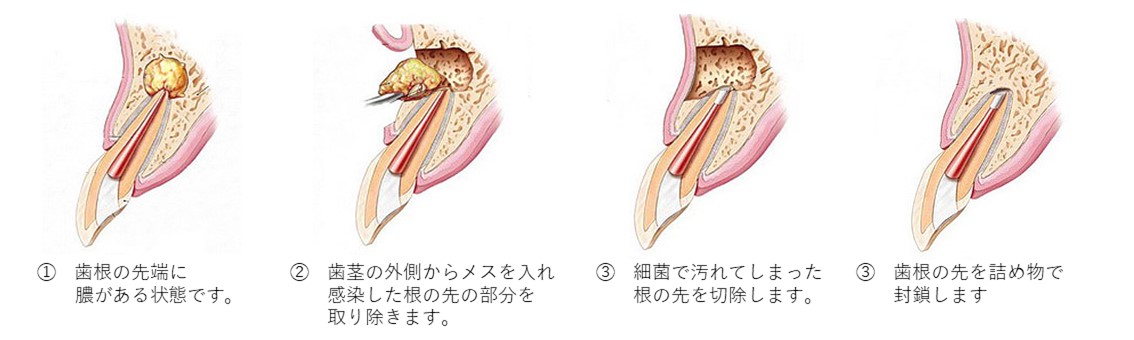 綾瀬の歯医者、新井歯科医院の根管治療