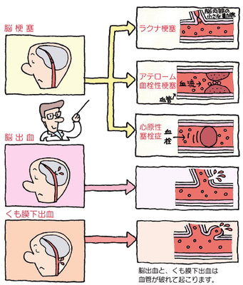 足立区綾瀬の歯医者　新井歯科医院　むし歯菌と脳卒中との関連が明らかに