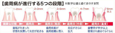 足立区綾瀬の歯医者 新井歯科医院 実は深い繋がりが!?糖尿病と歯の健康