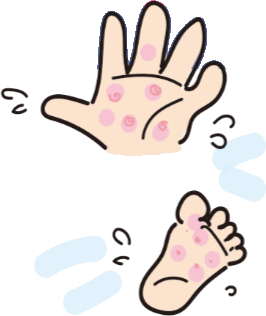 掌蹠膿疱症