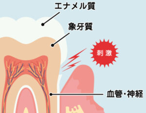 綾瀬の歯医者、新井歯科医院で、覚醒時ブラキシズムについての解説