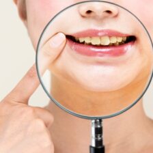 綾瀬の歯医者、新井歯科医院で、歯の黄ばみについての解説