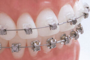 綾瀬の歯医者、新井歯科医院で、矯正治療の歯根吸収リスクについての解説