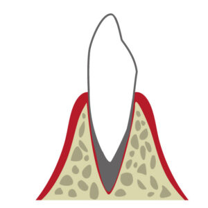 綾瀬の歯医者、新井歯科医院で、矯正治療の歯根吸収リスクについての解説