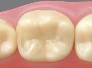 綾瀬の歯医者、新井歯科医院で、根管治療で通院間隔が空いてしまった！対処法やリスクを解説