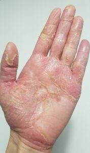 綾瀬の歯医者、新井歯科医院で、根管治療で通院間隔が空いてしまった！対処法やリスクを解説