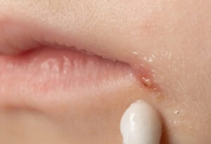 綾瀬の歯医者、新井歯科医院で、根管治療で通院間隔が空いてしまった！対処法やリスクを解説