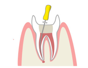 綾瀬の歯医者、新井歯科医院で、根管治療で通院間隔が空いてしまった！対処法やリスクを解説
