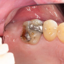 綾瀬の歯医者、新井歯科医院で、根管治療で通院間隔が空いてしまった！対処法やリスクを解説