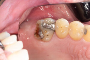 綾瀬の歯医者、新井歯科医院で、根管治療で通院間隔が空いてしまった！対処法やリスクを解説