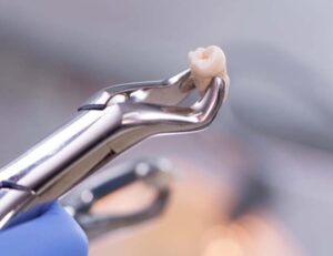 綾瀬の歯医者、新井歯科医院で、抜歯矯正と非抜歯矯正の違いとは？それぞれのメリット・デメリットを解説