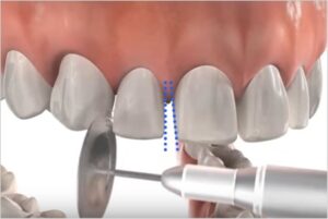 綾瀬の歯医者、新井歯科医院で、抜歯矯正と非抜歯矯正の違いとは？それぞれのメリット・デメリットを解説