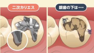 綾瀬の歯医者、新井歯科医院で、銀歯の下で進む二次カリエスの恐怖と早期発見のコツを解説