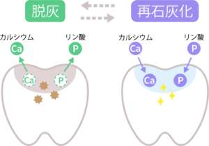綾瀬の歯医者、新井歯科医院で、矯正中のホワイトスポットを防ぐには？原因と予防法を解説