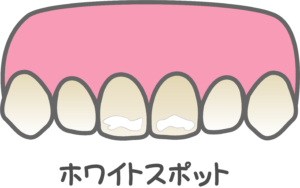 綾瀬の歯医者、新井歯科医院で、矯正中のホワイトスポットを防ぐには？原因と予防法を解説