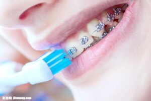 綾瀬の歯医者、新井歯科医院で、矯正中のホワイトスポットを防ぐには？原因と予防法を解説